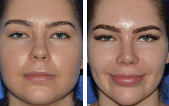 Slim face exercise, slimmer face, lose face fat, reduce face fat, face  slimming, small face 